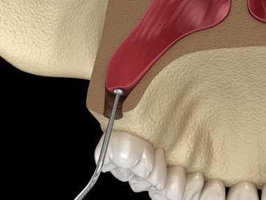 Sinüs Lift Cerrahisi - Sinüs Büyütme. 3d illüstrasyon
