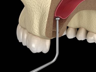 Sinüs Lift Cerrahisi - Sinüs Büyütme. 3d illüstrasyon