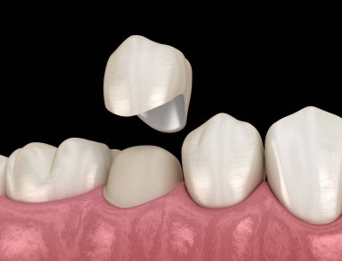 Diş taç premolar diş montaj işlemi. İnsan diş tedavisi tıbbi olarak doğru 3d illüstrasyon