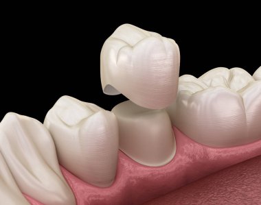 Diş taç premolar diş montaj işlemi. İnsan diş tedavisi tıbbi olarak doğru 3d illüstrasyon