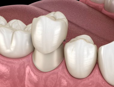 Diş taç premolar diş montaj işlemi. İnsan diş tedavisi tıbbi olarak doğru 3d illüstrasyon