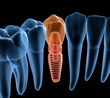 İmplant ile premolar diş kurtarma, x-Ray görünümü. İnsan dişleri ve protezkavramının tıbbi olarak doğru 3d illüstrasyon