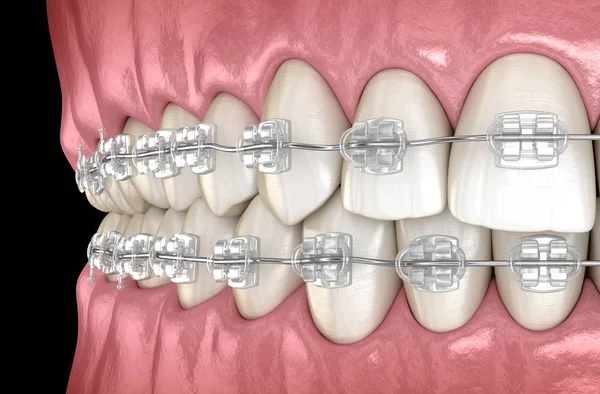 Denti Bretelle Chiare Nelle Gengive Illustrazione Dentale Clinicamente Accurata — Foto Stock