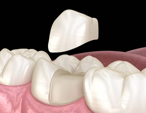 Onlay Fissaggio Corona Ceramica Sopra Dente Illustrazione Clinicamente Accurata Del — Foto Stock
