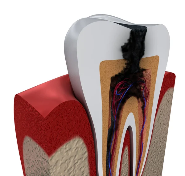 Diş Çürümesi Tıbbi Olarak Doğru Diş Illüstrasyon — Stok fotoğraf