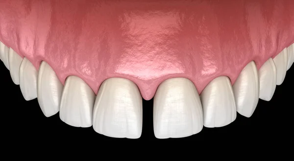 Diastema Dentes Incisivos Centrais Disfunção Dentária Ilustração Conceito — Fotografia de Stock