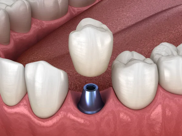 Premolaire Tand Kroon Installatie Implantaat Abutment Medisch Nauwkeurige Illustratie Van — Stockfoto