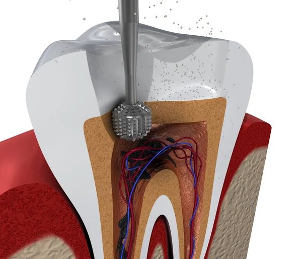 Processo Tratamento Canal Radicular Ilustração — Fotografia de Stock