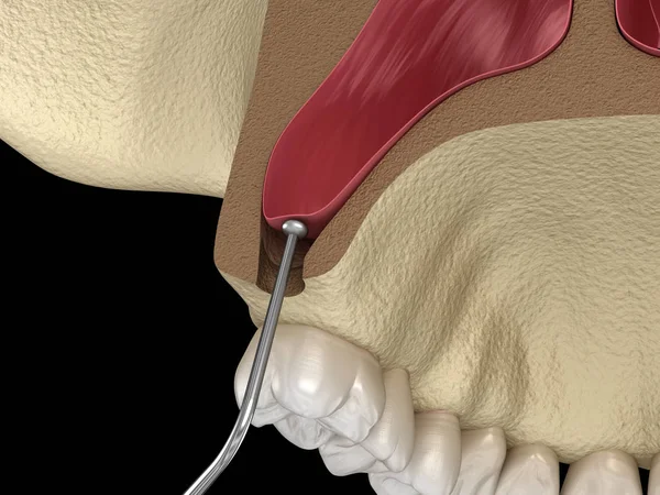 Soulèvement Sinusal Chirurgie Augmentation Sinusale Illustration — Photo