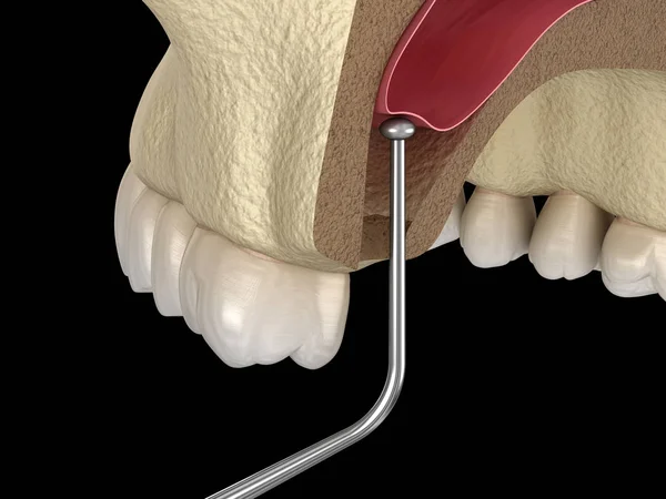 Cirurgia Elevação Sinusal Aumento Sinusal Ilustração — Fotografia de Stock