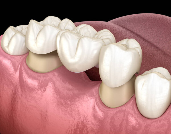Dental bridge of 3 teeth over molar and premolar. Medically accurate 3D illustration of human teeth treatment