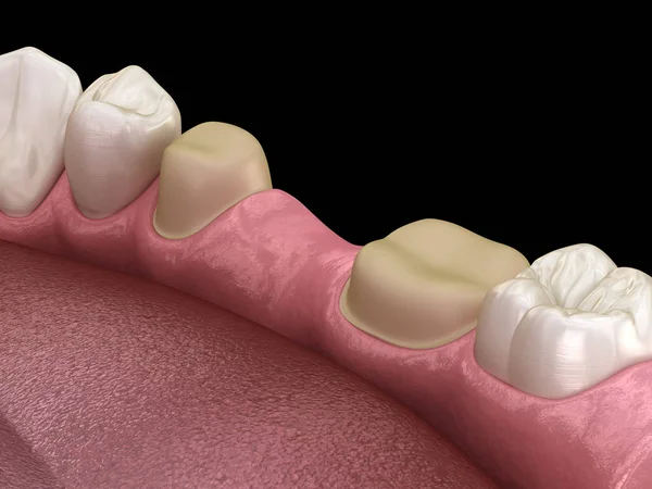 Przygotowany Ząb Trzonowy Przedtrzonowy Umieszczenia Mostu Zębowego Medycznie Dokładna Ilustracja — Zdjęcie stockowe