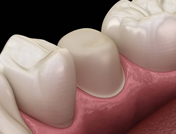Παρασκευωμένο Προμοριακό Δόντι Για Τοποθέτηση Οδοντικής Στεφάνης Ιατρική Ακρίβεια Εικονογράφηση — Φωτογραφία Αρχείου