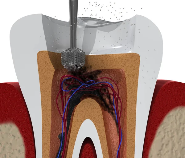 Root canal treatment process. 3D illustration