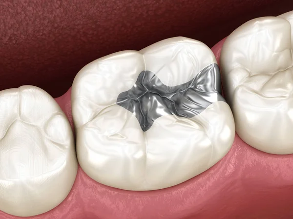 Inlay silver crown fixation over tooth. Medically accurate 3D illustration of human teeth treatment