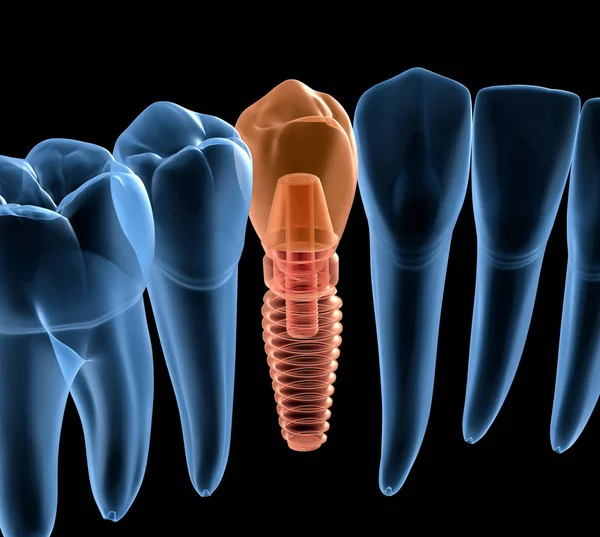 İmplant ile premolar diş kurtarma, x-Ray görünümü. İnsan dişleri ve protezkavramının tıbbi olarak doğru 3d illüstrasyon