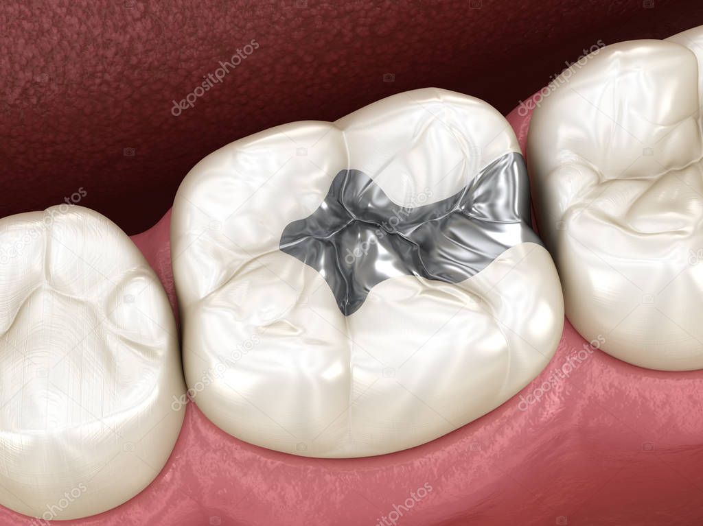 Inlay silver crown fixation over tooth. Medically accurate 3D illustration of human teeth treatment