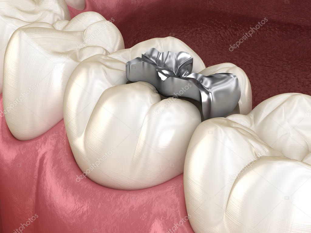 Inlay silver crown fixation over tooth. Medically accurate 3D illustration of human teeth treatment