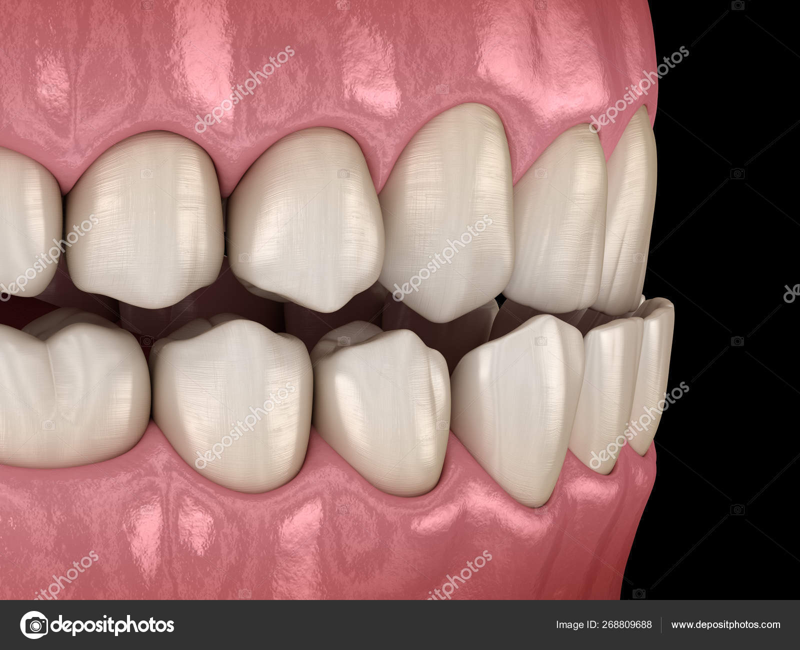 Underbite Dental Occlusion Malocclusion Teeth Medically Accurate Tooth