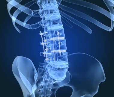 Spinal fiksasyon sistemi - titanyum braket. X-Ray 3d illüstrasyon