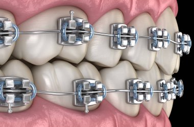 Diş etlerinde metal parantez olan dişler. Tıbbi olarak doğru diş 3d illüstrasyon