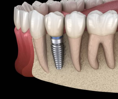 Premolar tooth recovery with implant. Medically accurate 3D illustration of human teeth and dentures concept clipart