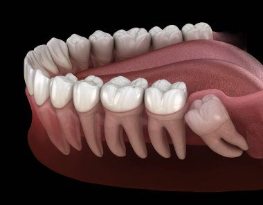 Mesial impaction ile sağlıklı dişler ve bilgelik diş . Tıbbi olarak doğru diş 3d illüstrasyon