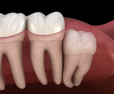 Dikey impaction ile sağlıklı dişler ve bilgelik diş . Tıbbi olarak doğru diş 3d illüstrasyon