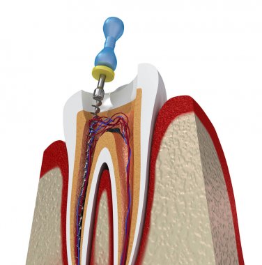 Root canal treatment process. 3D illustration clipart