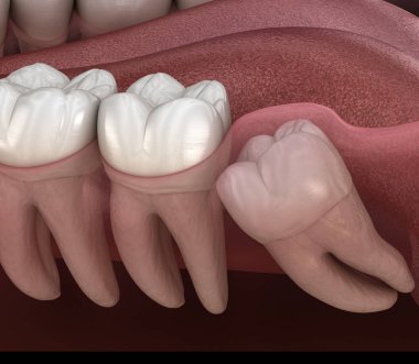 Mesial impaction ile sağlıklı dişler ve bilgelik diş . Tıbbi olarak doğru diş 3d illüstrasyon
