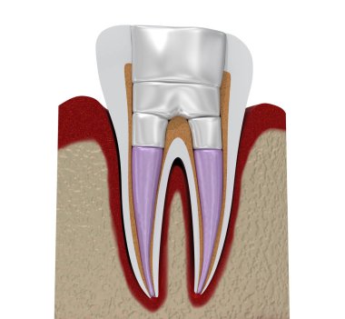 Diş dolguları prosedür diyagramı . 3d illüstrasyon