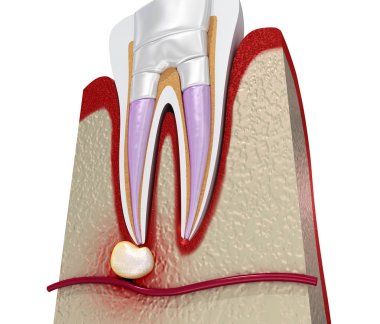 Diş dolguları prosedür diyagramı . 3d illüstrasyon
