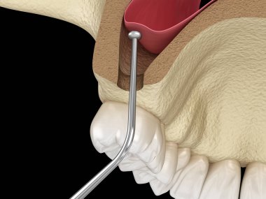Sinüs Lift Cerrahisi - Sinüs Büyütme. 3d illüstrasyon