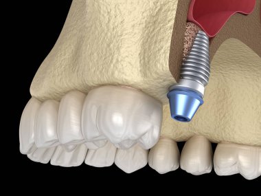 Sinüs gerdirme cerrahisi - implant kurulumu. 3B illüstrasyon