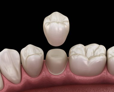 Diş taç premolar diş montaj işlemi. İnsan diş tedavisi tıbbi olarak doğru 3d illüstrasyon