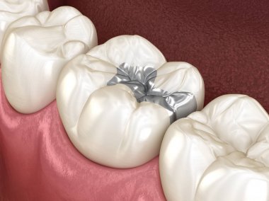 Inlay silver crown fixation over tooth. Medically accurate 3D illustration of human teeth treatment clipart