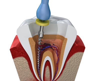Root canal treatment process. 3D illustration clipart