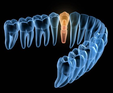 İmplant ile premolar diş kurtarma, x-Ray görünümü. İnsan dişleri ve protezkavramının tıbbi olarak doğru 3d illüstrasyon