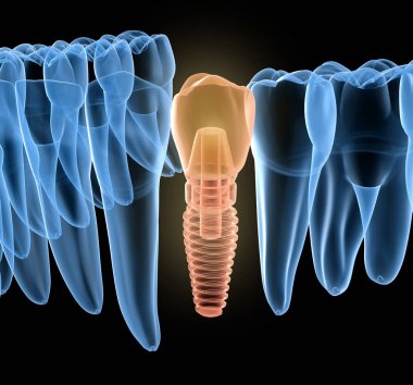 İmplant ile premolar diş kurtarma, x-Ray görünümü. İnsan dişleri ve protezkavramının tıbbi olarak doğru 3d illüstrasyon