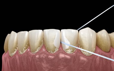 Ağız hijyeni: plak çıkarma için diş ipi kullanarak. Tıbbi olarak doğru diş 3d illüstrasyon