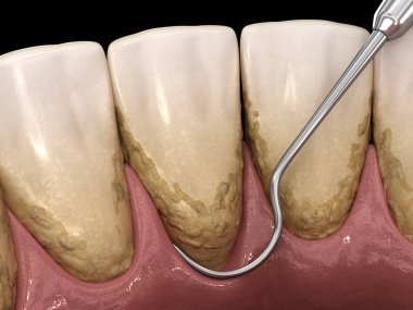 Ağız temizliği: Ölçekleme ve kök planlama (geleneksel periodontal terapi). İnsan diş tedavisinin tıbbi açıdan doğru üç boyutlu çizimi