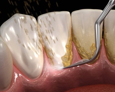 Ağız hijyeni: Ultrasonik diş temizleme makinesi kalkülüs ve plak kaldırma. İnsan diş tedavisi tıbbi olarak doğru 3d illüstrasyon