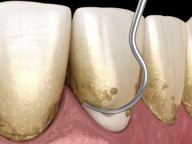 Ağız temizliği: Ölçekleme ve kök planlama (geleneksel periodontal terapi). İnsan diş tedavisinin tıbbi açıdan doğru üç boyutlu çizimi