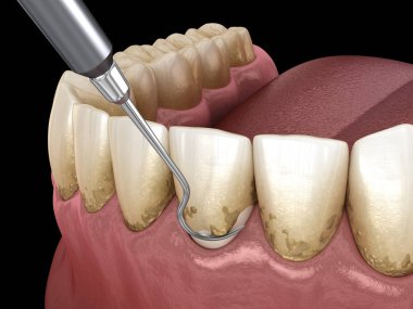 Ağız temizliği: Ölçekleme ve kök planlama (geleneksel periodontal terapi). İnsan diş tedavisinin tıbbi açıdan doğru üç boyutlu çizimi