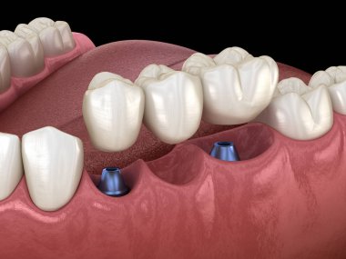 Diş köprüsü implantlarla destekleniyor. İnsan dişleri ve protez kavramının tıbben doğru üç boyutlu çizimi