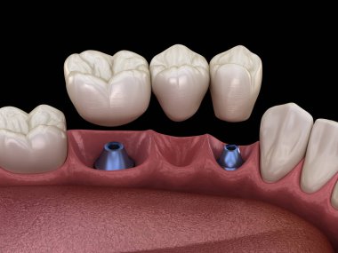 Diş köprüsü implantlarla destekleniyor. İnsan dişleri ve protez kavramının tıbben doğru üç boyutlu çizimi