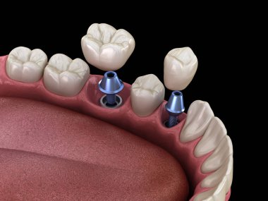 Premolar ve Molar diş taç implant abutments üzerinde kurulum. İnsan dişleri ve protezkavramının tıbbi olarak doğru 3d illüstrasyon