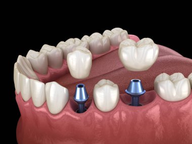 Premolar ve Molar diş taç implant abutments üzerinde kurulum. İnsan dişleri ve protezkavramının tıbbi olarak doğru 3d illüstrasyon