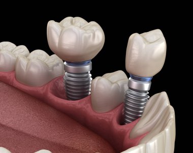 Premolar ve Molar diş taç implant abutments üzerinde kurulum. İnsan dişleri ve protezkavramının tıbbi olarak doğru 3d illüstrasyon