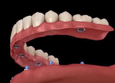 Çene protezi. Hepsi de implantlarla desteklenen 6 sistemde. İnsan dişleri ve protez kavramının tıbben doğru üç boyutlu çizimi